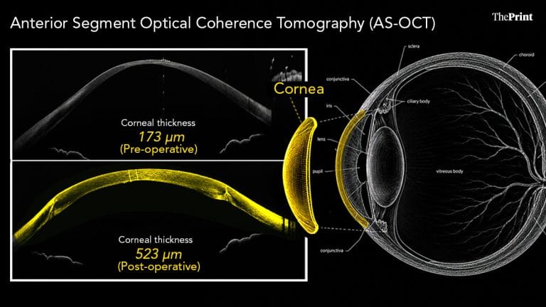 Discarded donor corneas could get a new life. How AIIMS trial can ease India’s cornea shortage