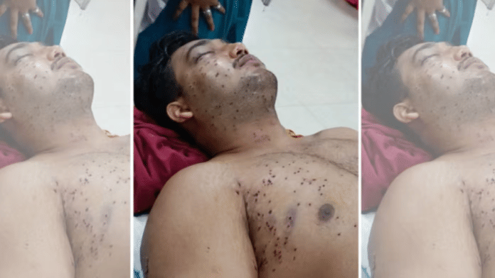 Sahil Lohchab, a resident of Delhi’s Najafgarh, was among those also allegedly sustained pellet injuries. | By special arrangement