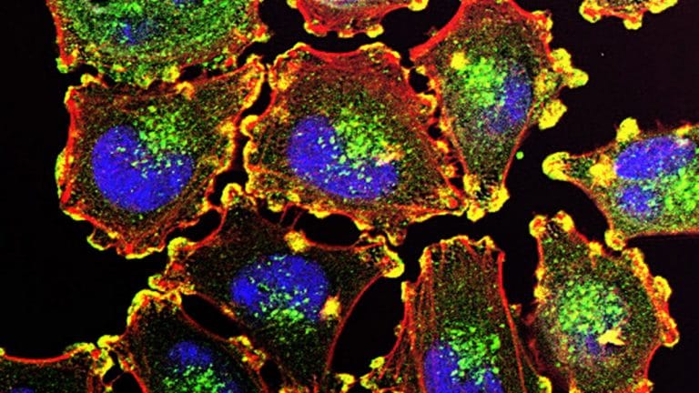 Indian scientists build AI tool to spot hidden cancer cells. It outperforms other methods