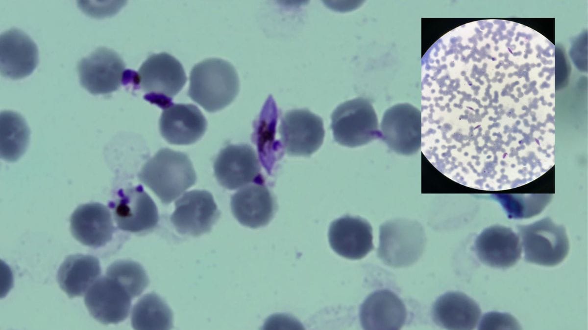 A closer view of mature Gametocytes—sexual stage of the malaria parasite—under the microscope. Gametocyte is an important stage responsible for transmission from infected humans to mosquitoes. (Inset) Mature Gametocytes look sickle-shaped under the microscope, ready to be picked up by mosquitoes | Sneha Richhariya | ThePrint