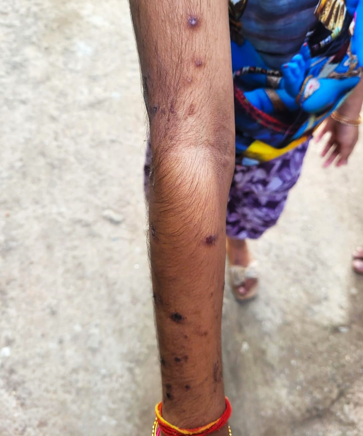 Local residents display signs of chemical ulcers, rashes, and blisters on their bodies | By special arrangement