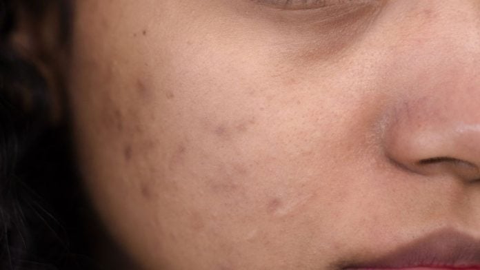 People with apparently similar acne scars may receive completely different treatment plans | Photo: Ron Lach | Pexels