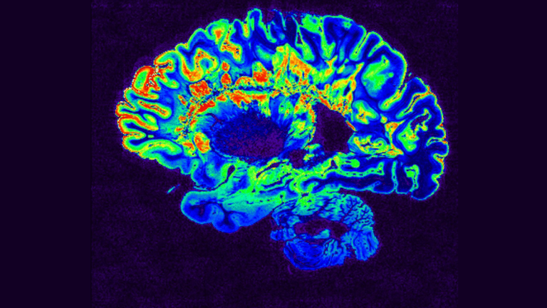Does air pollution cause dementia? What new studies say on what it does to the brain